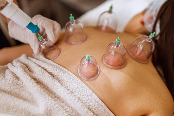 16554-cupping-therapy